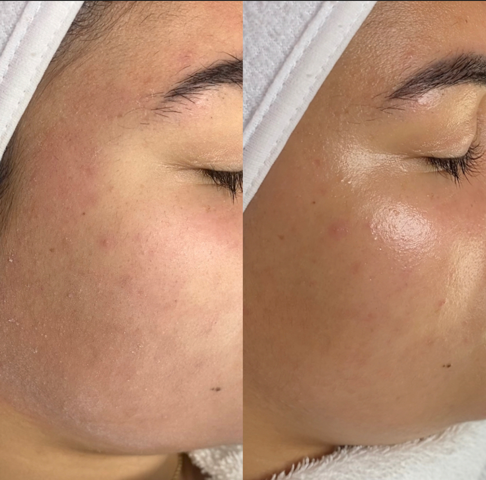 Microdermabrasion