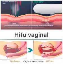 Monthly Sale 5 Hifu Vaginal Rejuven