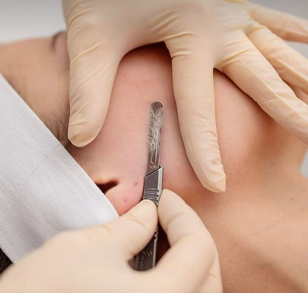 Dermaplaning Facial