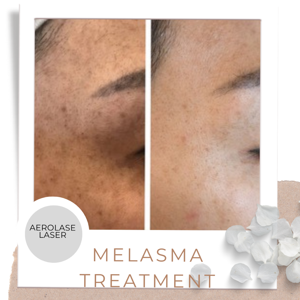 Melasma Laser Treatment Package