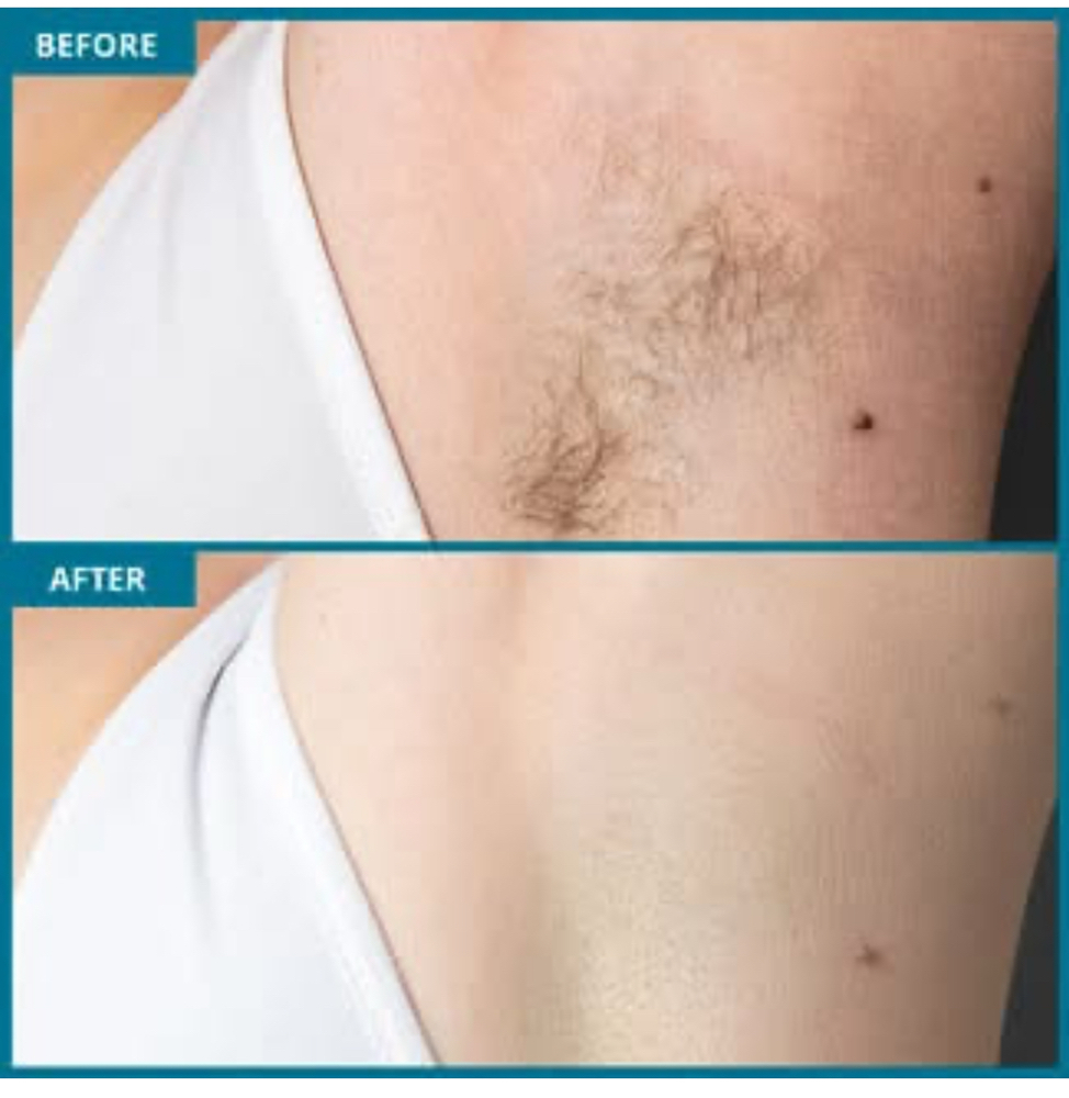 Hair Removal  Depilacion Laser