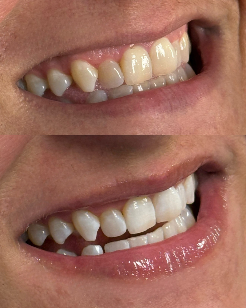 Teeth Whitening - LIMITED TIME RATE