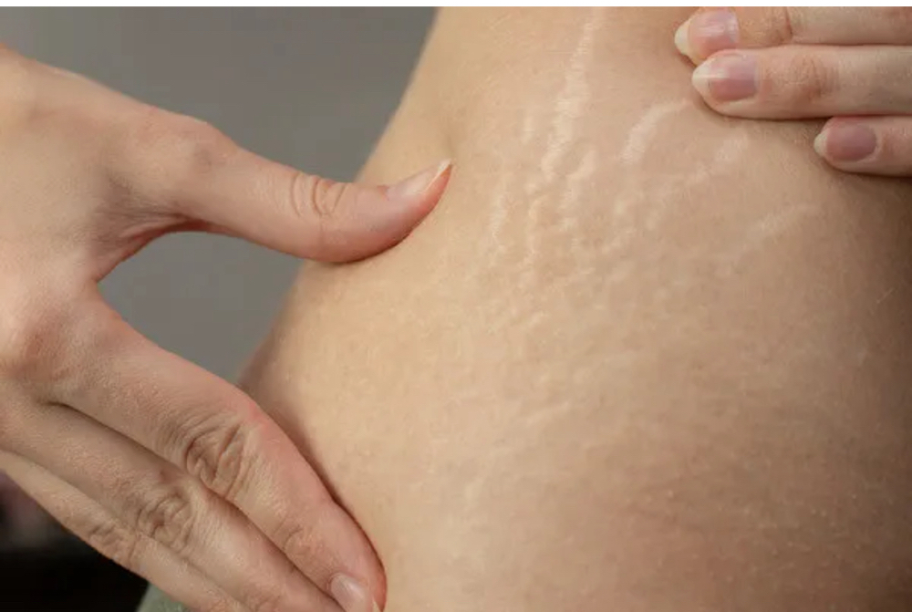 Stretch Mark and Scar Camouflage