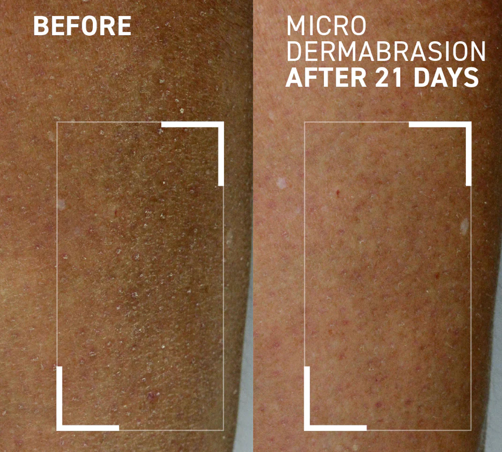 Microdermabrasion On Arms