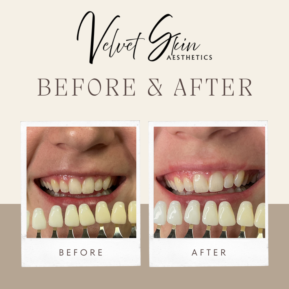 Teeth Whitening