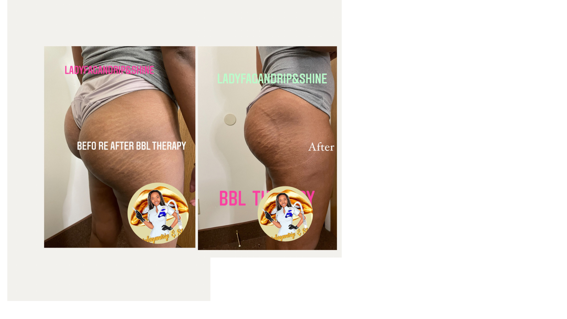 plum cellulite treatment5 SESSIONS