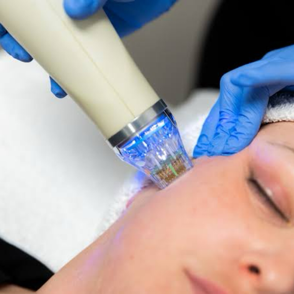 Micro-needling RF at Monarch Esthetics in Phoenix, AZ