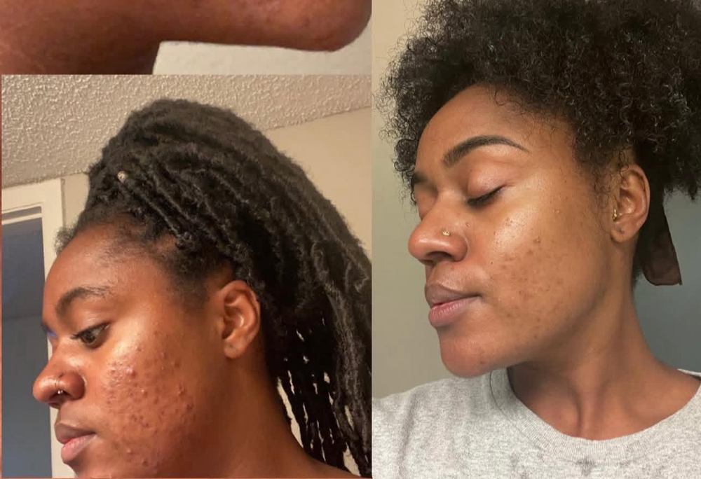 Acne Bootcamp