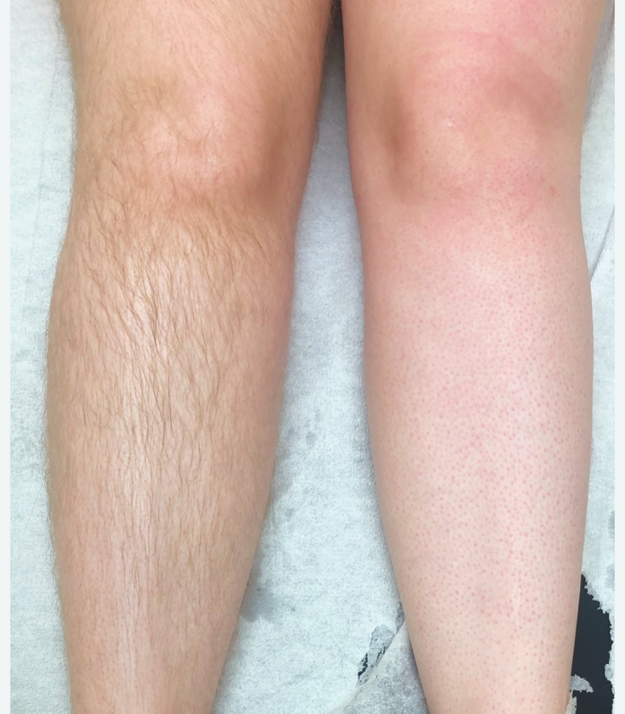Waxing Upper Leg