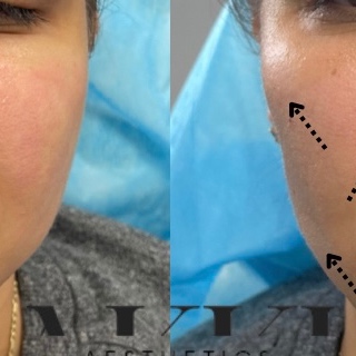 Cheek Filler (ML) at Akki Aesthetics in Williston Park, NY