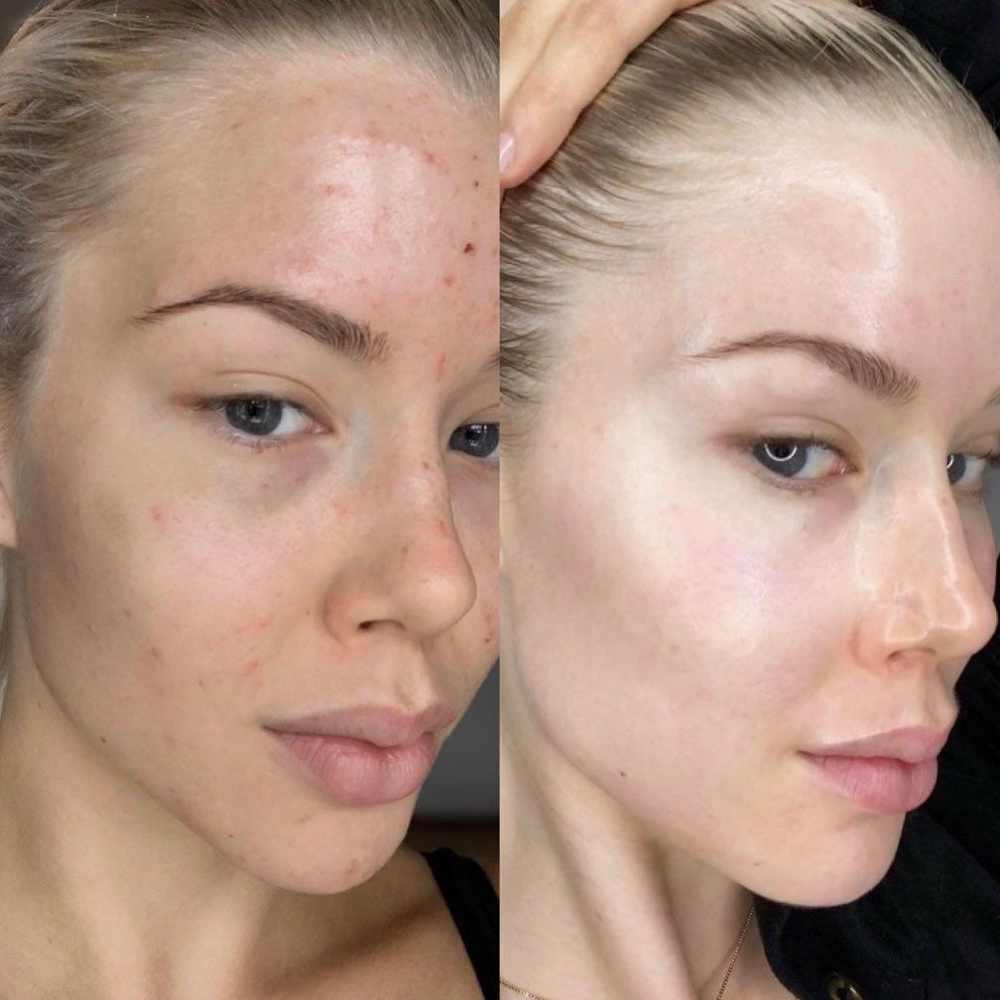 Medical Grade Chemical Peel