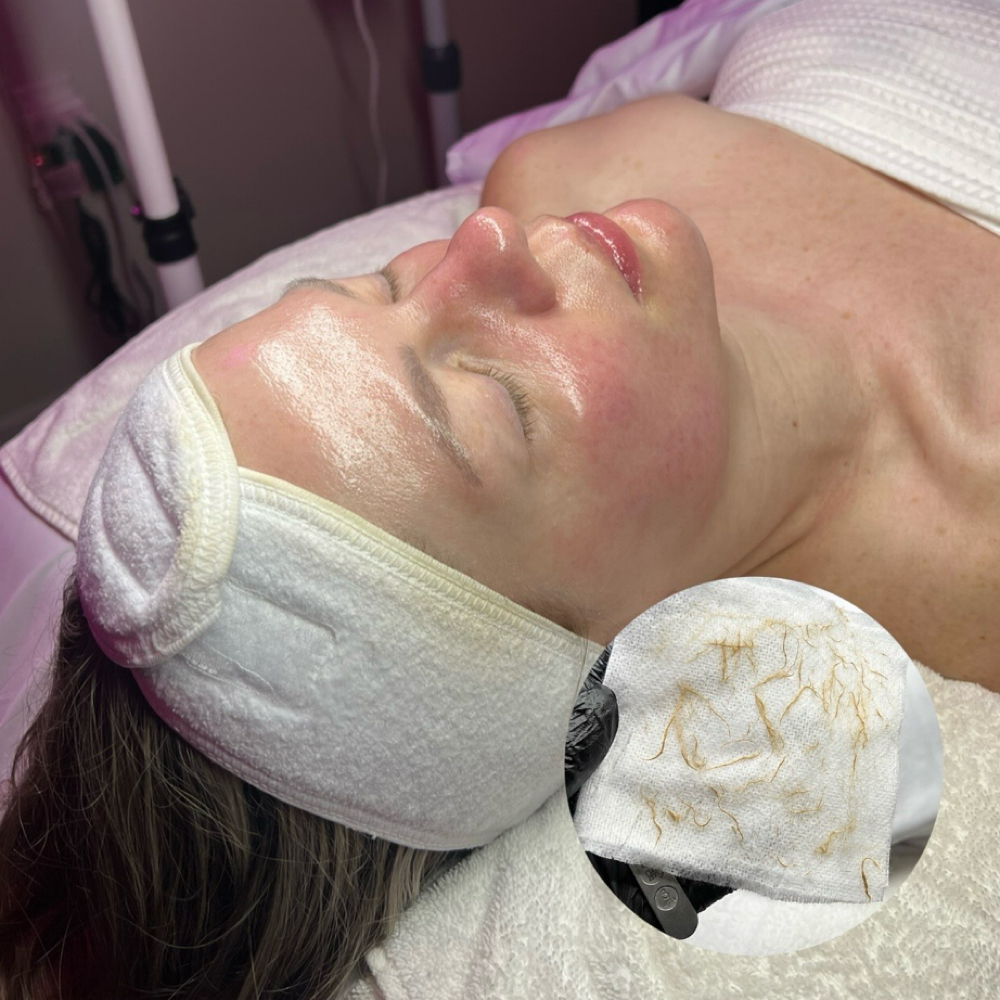Dermaplane Glow Facial at FacebyMeriee in Williamsville, NY
