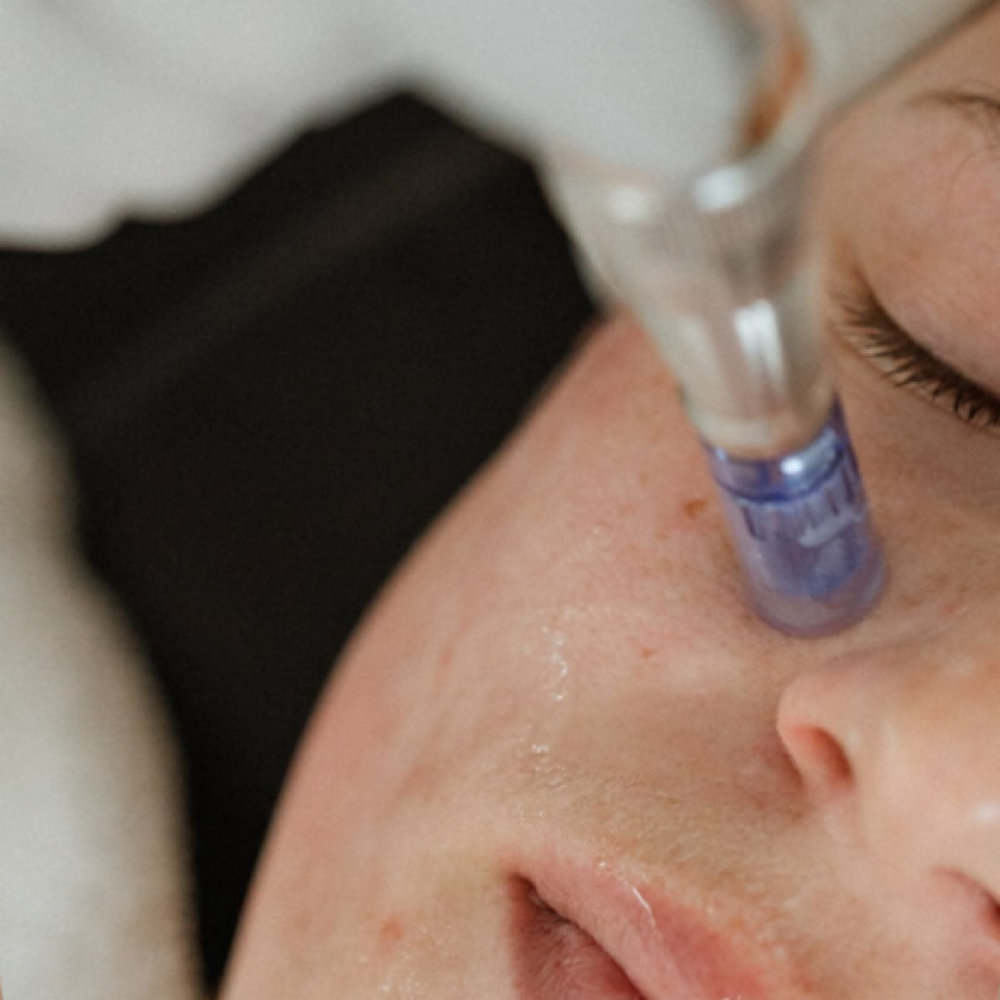 Microneedling Treatment at Hairbend the Salon in Lancaster, CA
