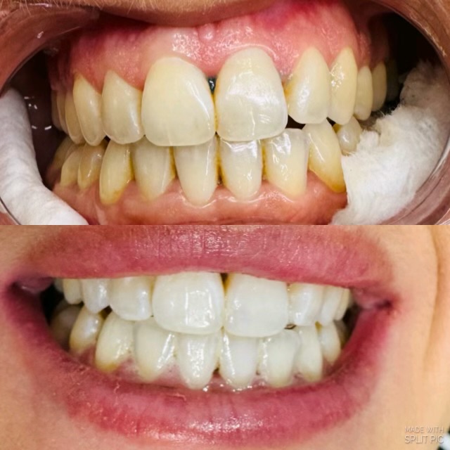 Teeth Whitening