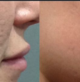 MicroNeedling 4x Package
