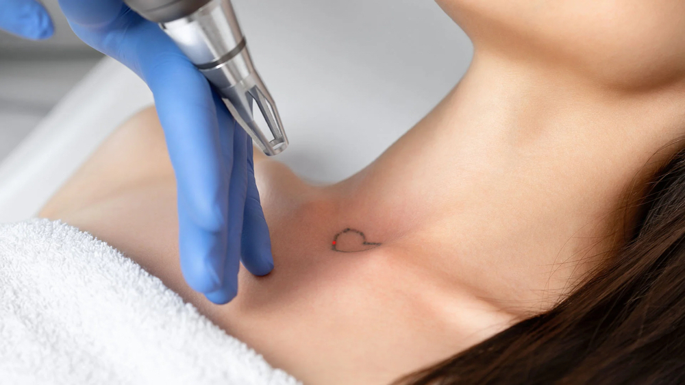 LASER TATTOO REMOVAL