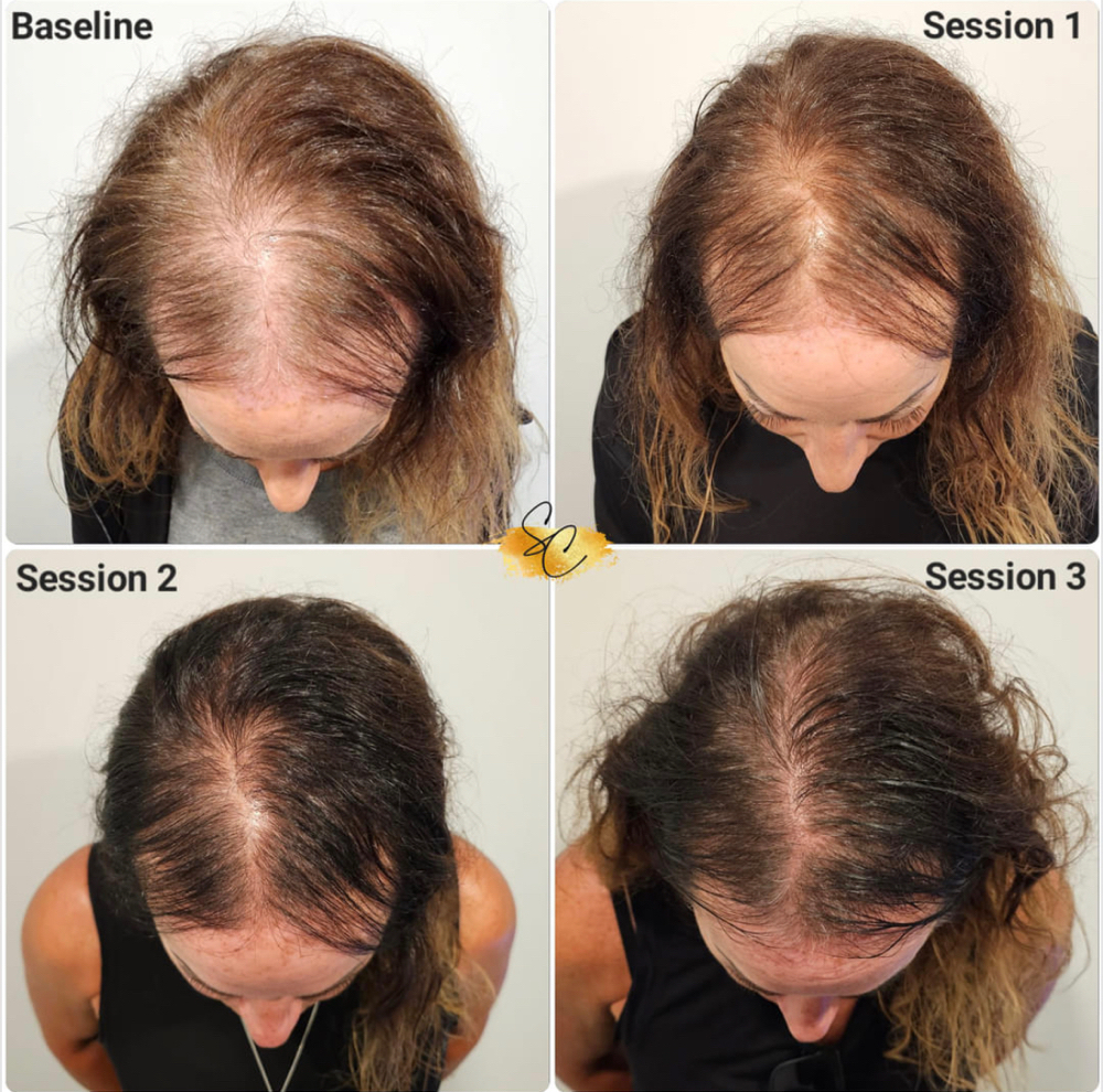 Consultation for hair restoration