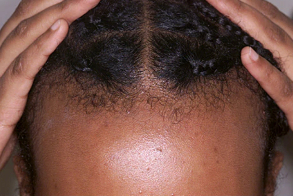 HAIR LOSS TREATMENTS