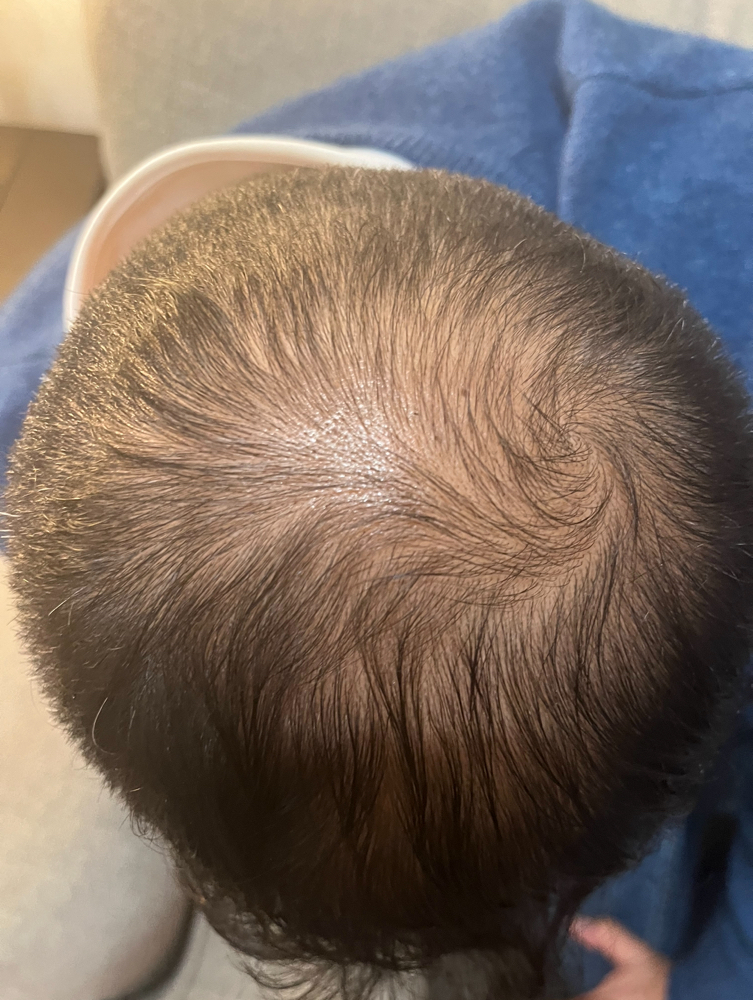 Hair And Scalp Restoration Therapy