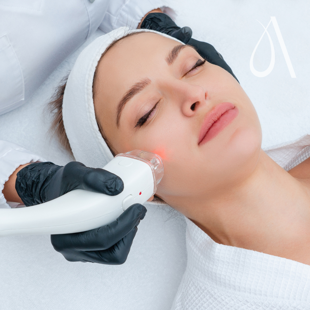 Laser - Full face - 1 session at Ambar Aesthetics in Kissimmee, FL