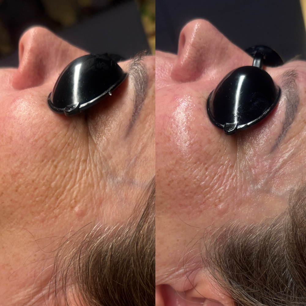 Glow Tox Lifting Facial at MySkin Aesthetics in Laredo, TX