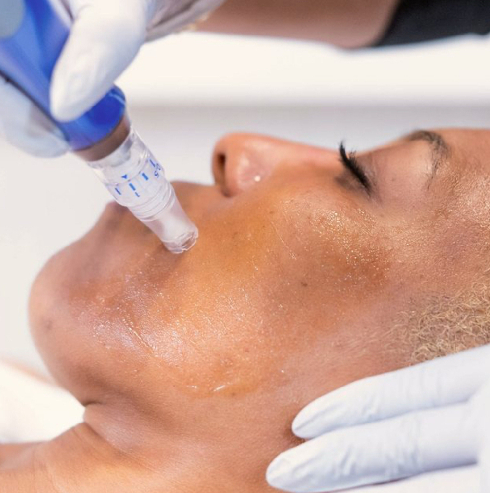 Microneedling