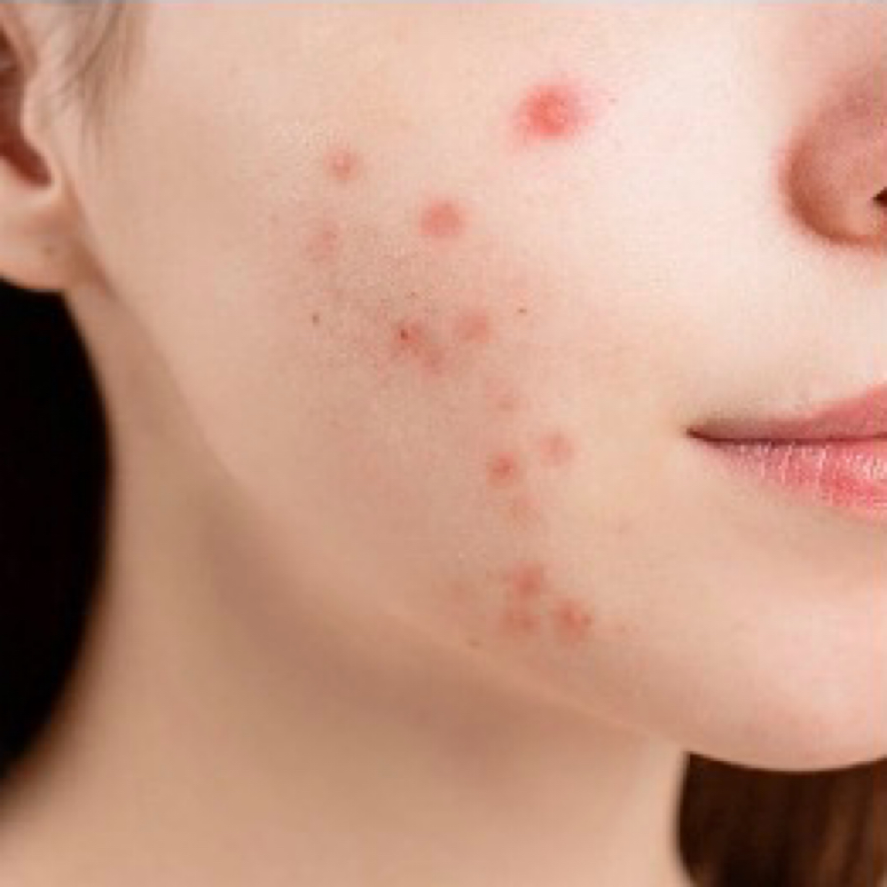 Teen Facial Series Of 3 at TOUCH OF LUXURY SPA in Cypress, TX