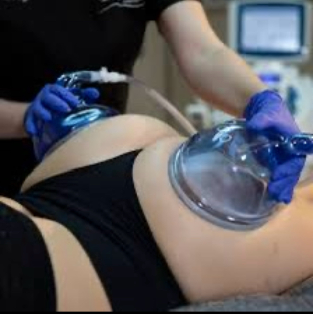 Non-surgical Butt Lift