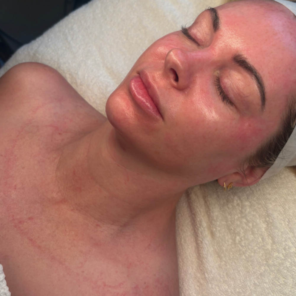 Oxygen² Lift Facial Treatmnet at AK Aesthetics in Downers Grove, IL