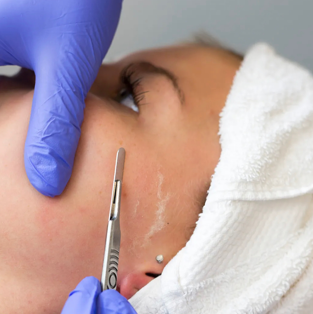 DERMAPLANING