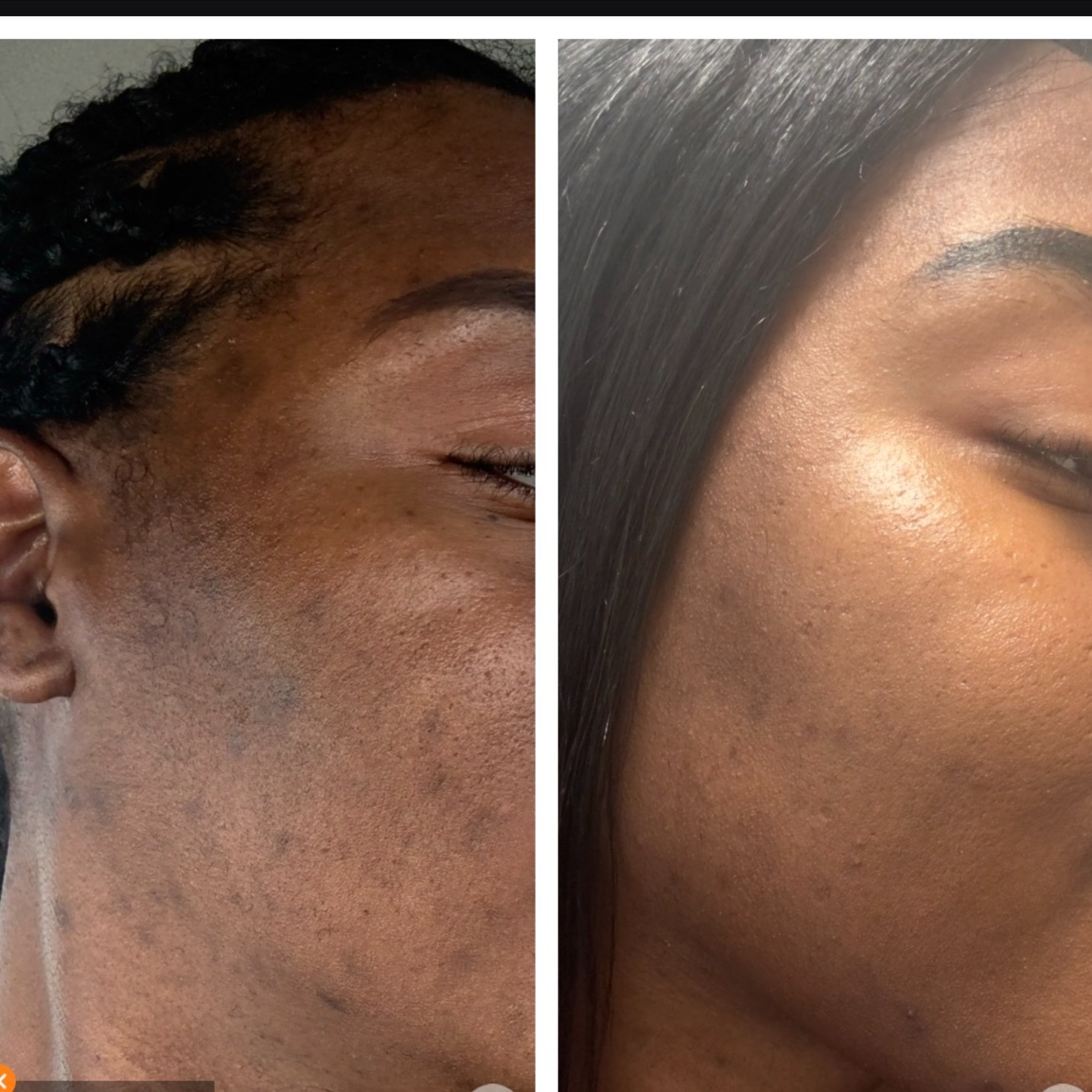 Level 3 Corrective Treatment at Velnaira in Lakewood, CA