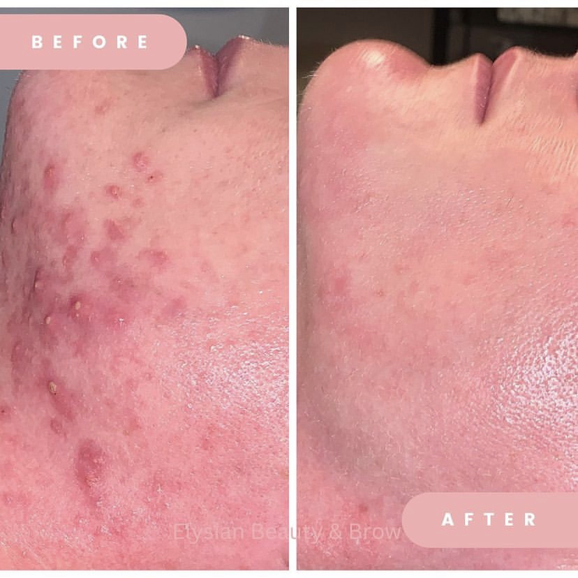 FaceReality Acne Consultation