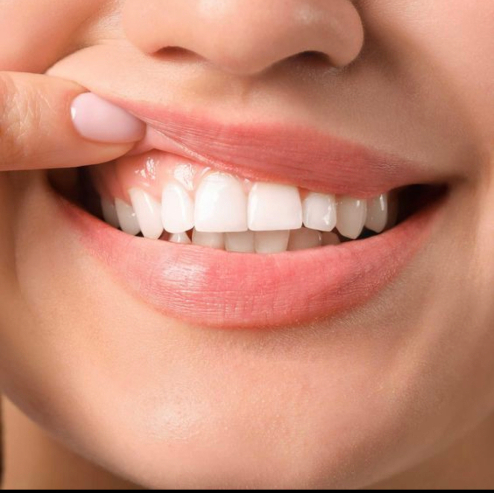 Teeth Whitening