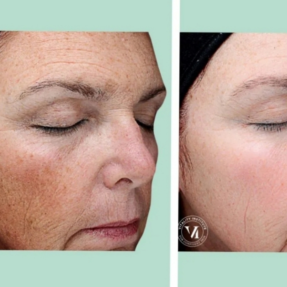 VI PEEL at LOOKATHER SKINBODY&LASHES AESTHETICS in Roswell, GA
