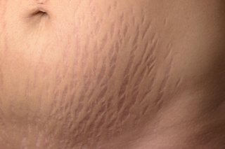 Inkless Stretchmark Revision