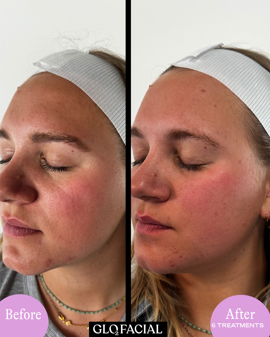 RF PRO Theraputic Facial