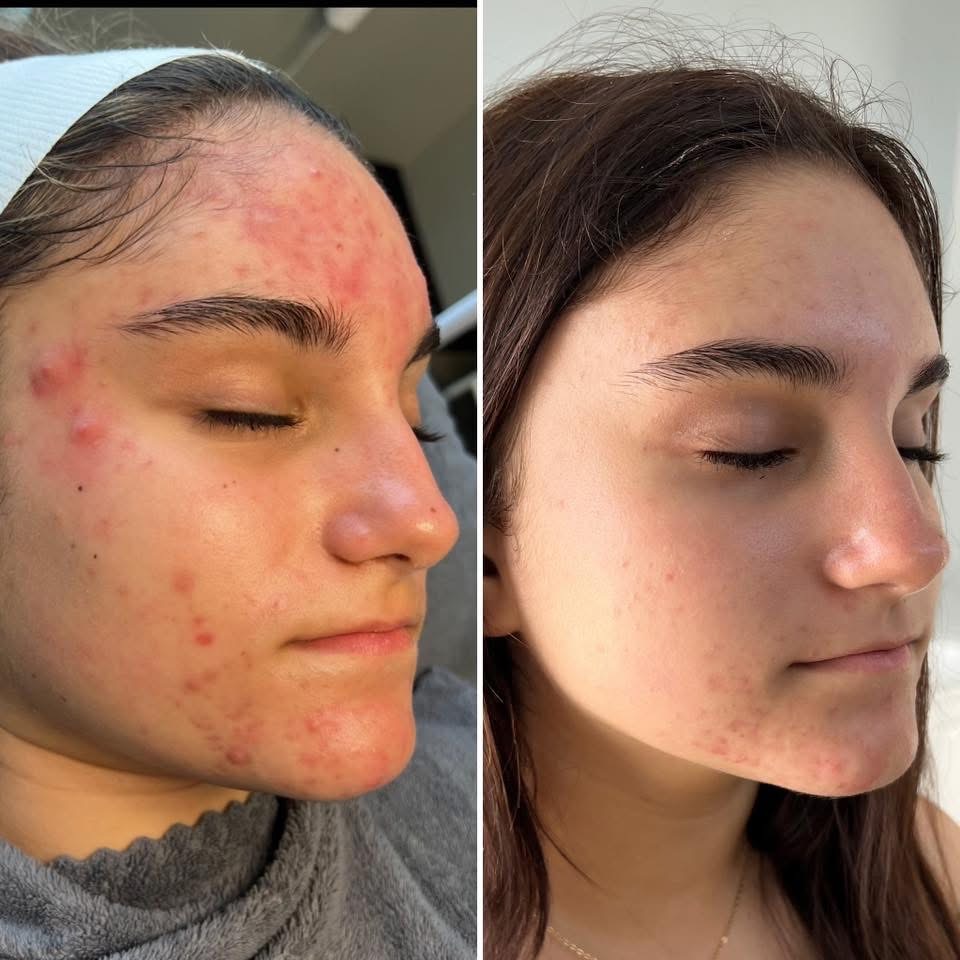 6 Week Clear Skin Program