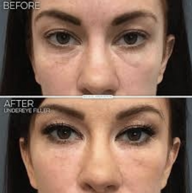 Under Eye Filler/ Brightening