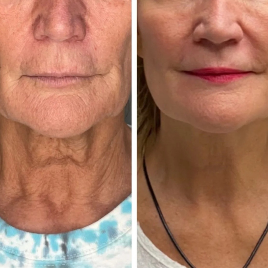 Tixel neck at Marco Island Aesthetics