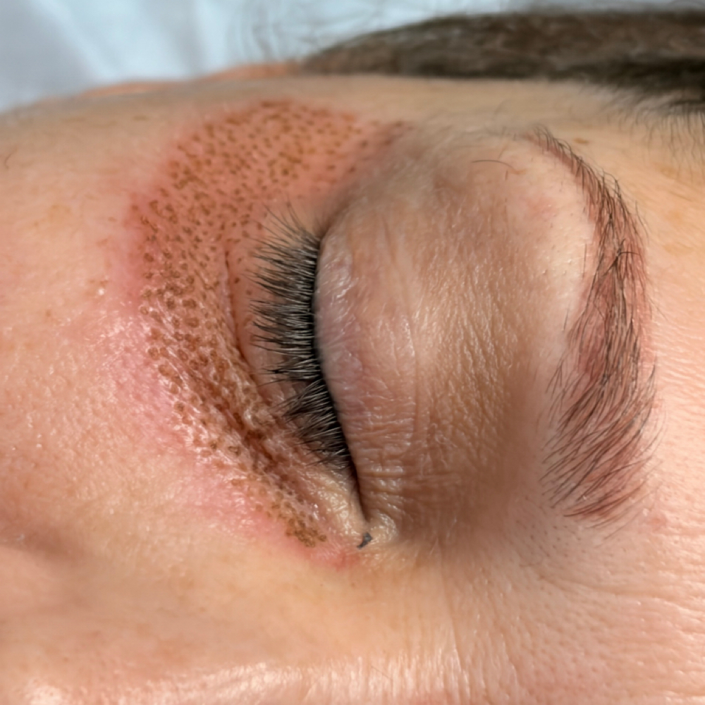 Fibroblast Eyes Upper Or Lower at Skin Fixation & Esthetic Training in Port Saint Lucie, FL