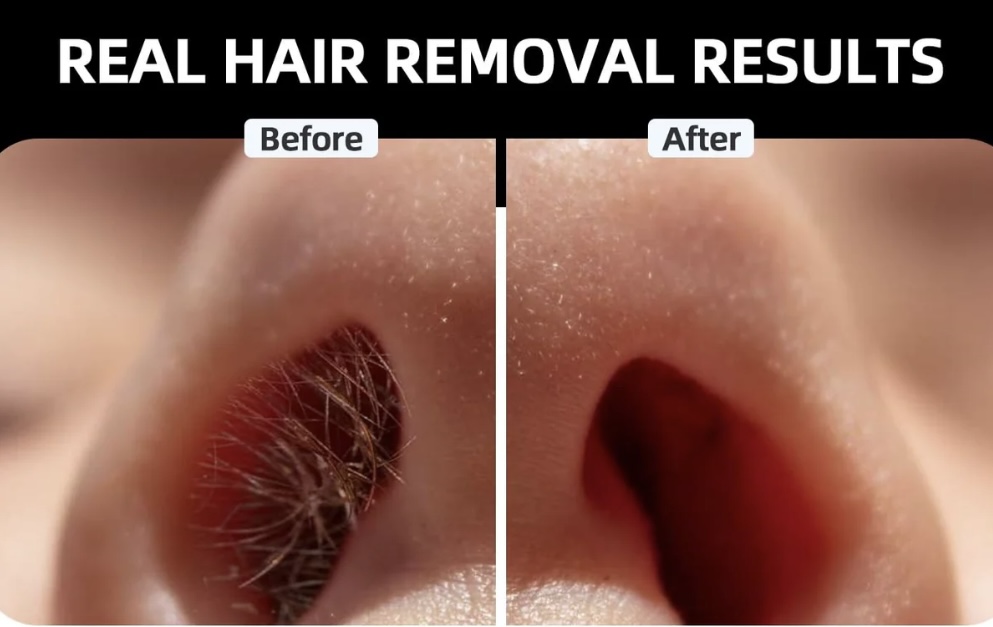 Nasal Hair Removal