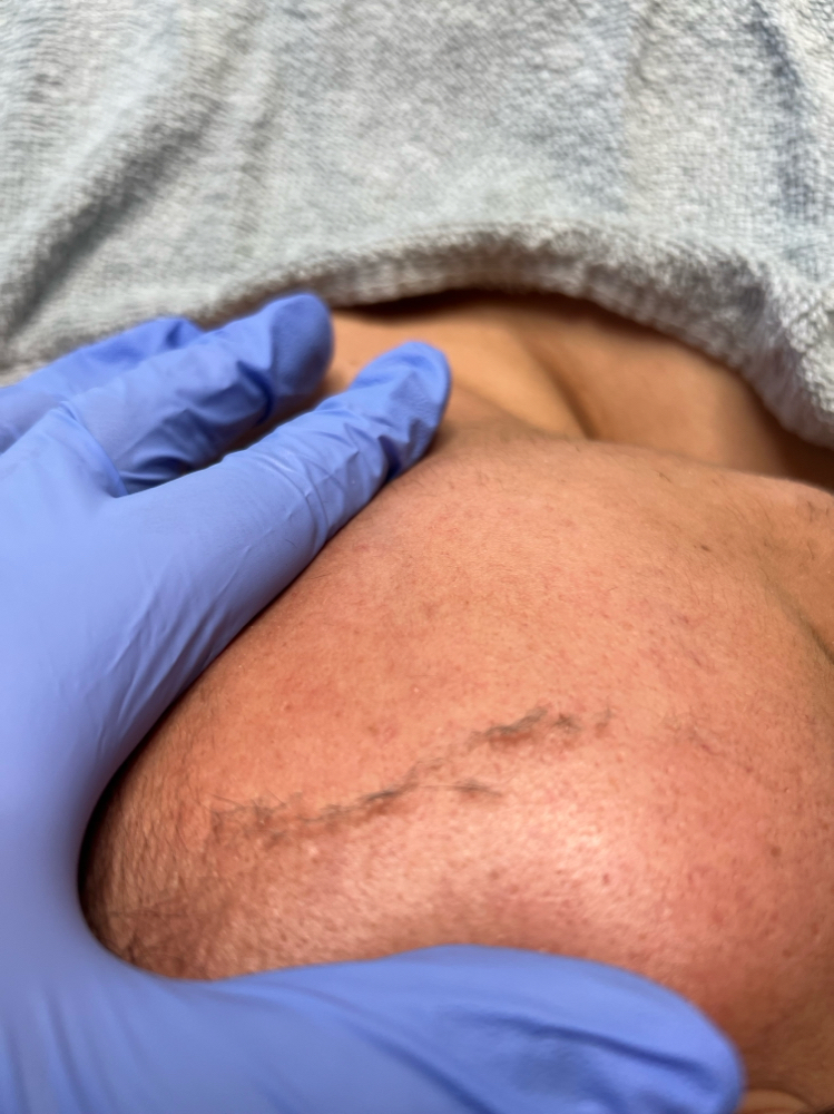 Epidermal Leveling