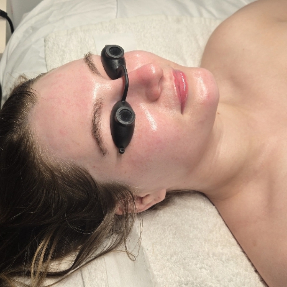 Chemical Peel at CareBeautyDerm in Smithtown, NY