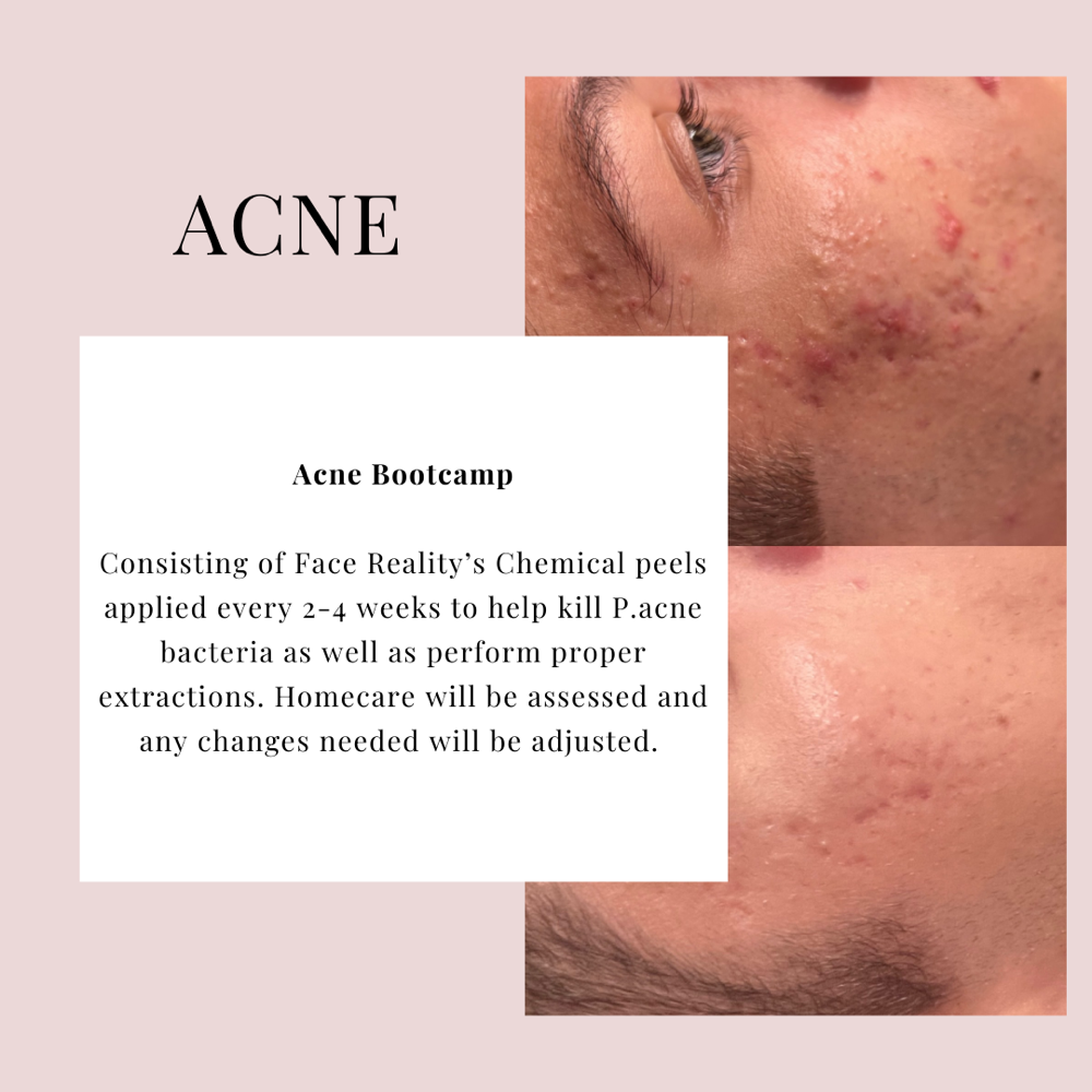 Acne Bootcamp