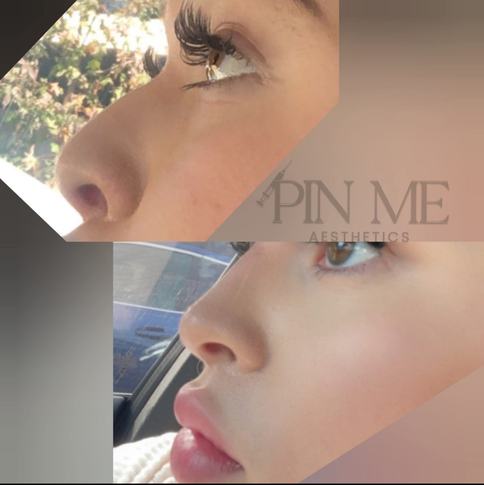 Pixie Nose Lift at Pin Me Aesthetics PLLC in Alvin, TX