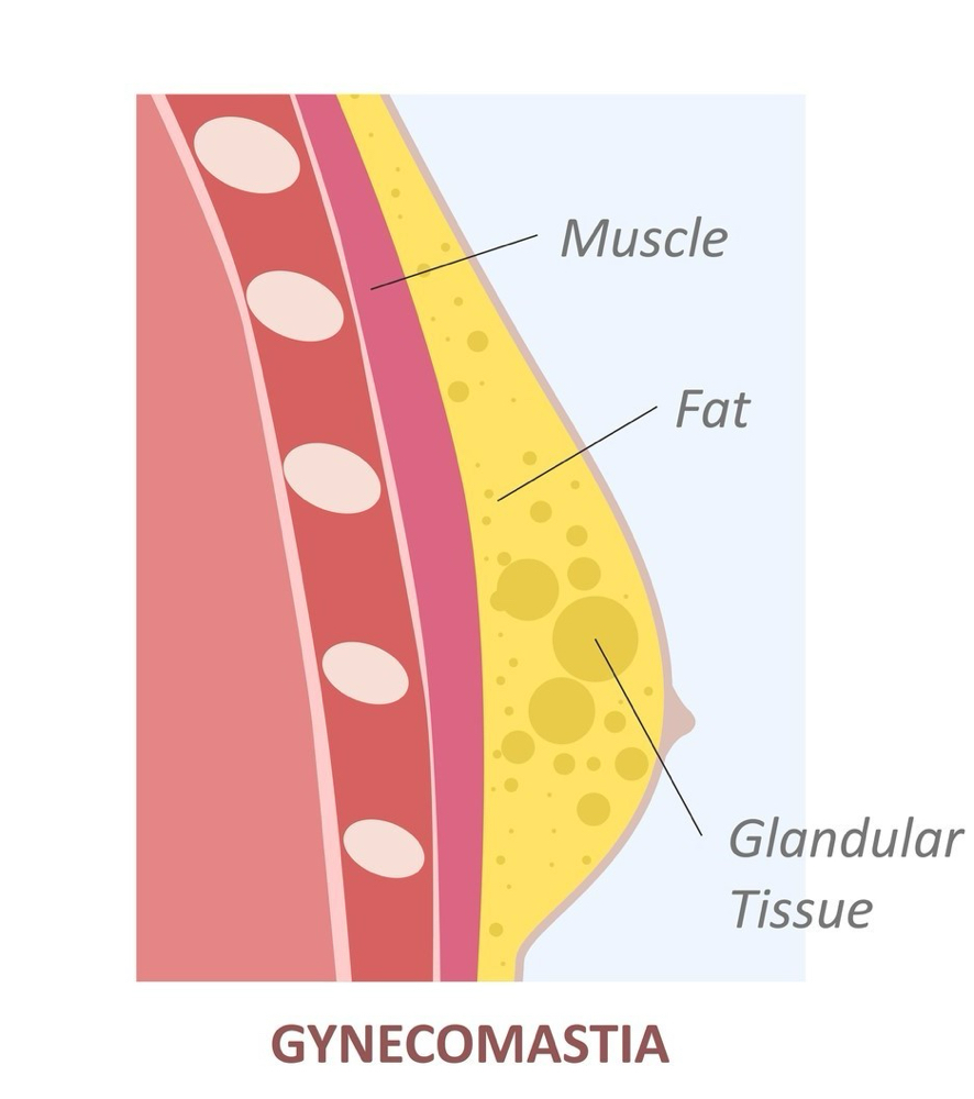 Noninvasive Breast Reduction