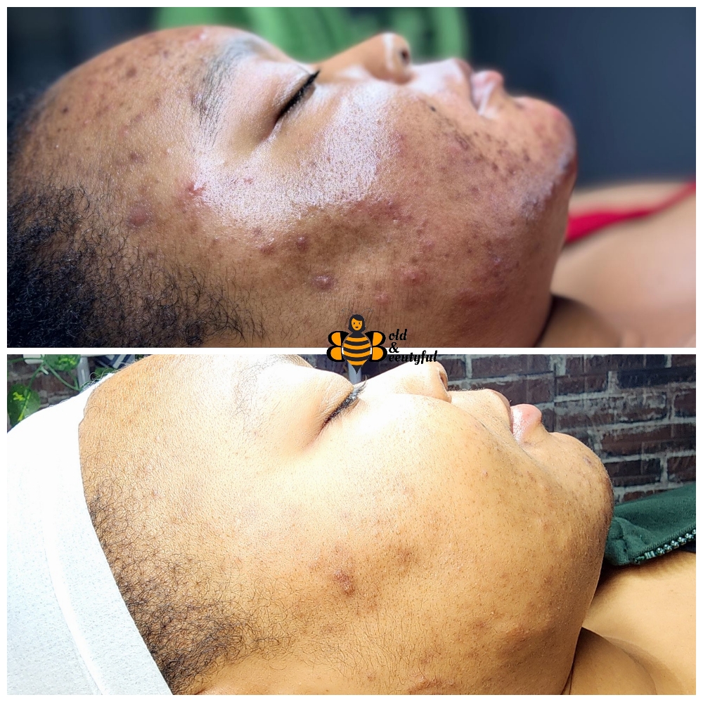 3 Acne Treatment Facial