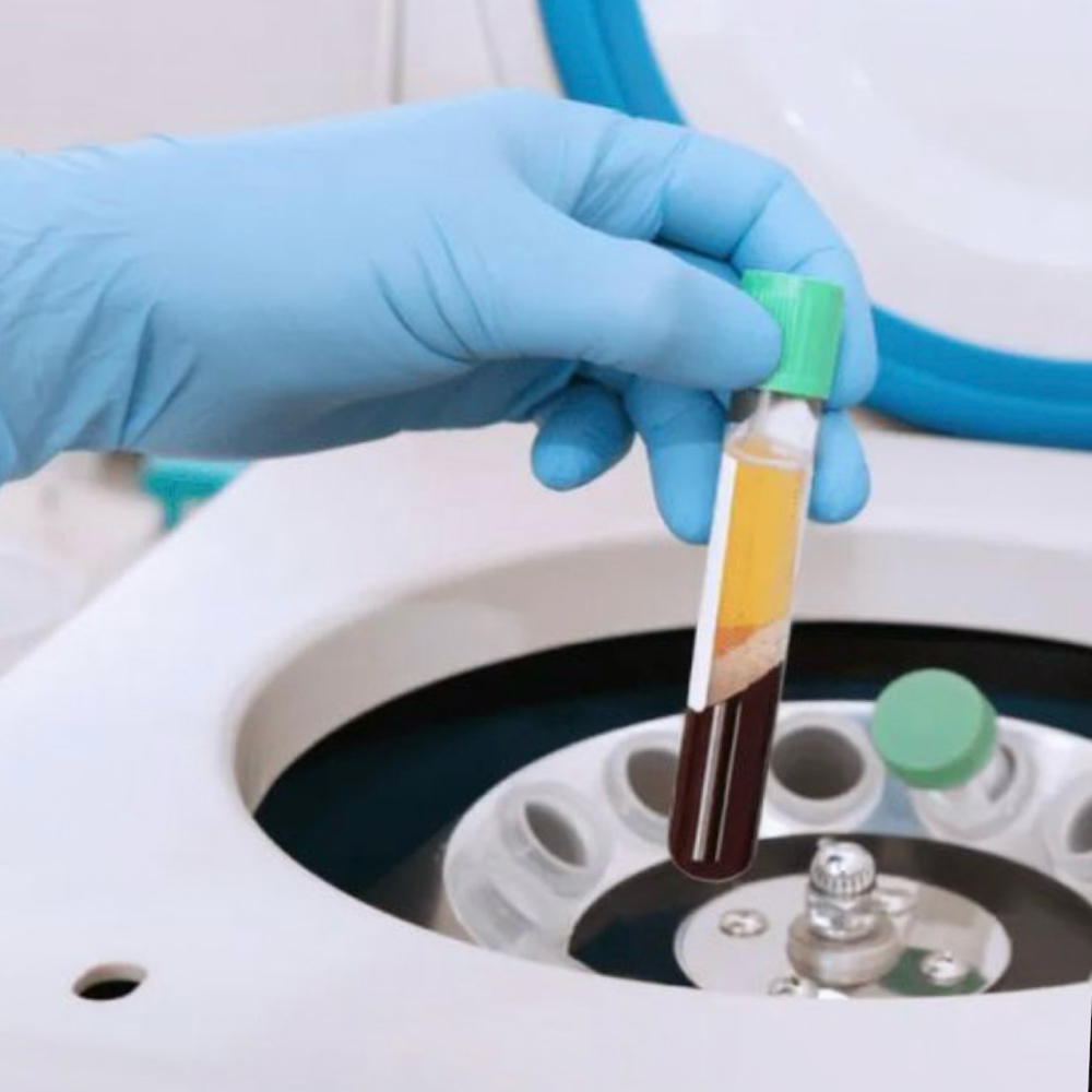 PRP Microneedling