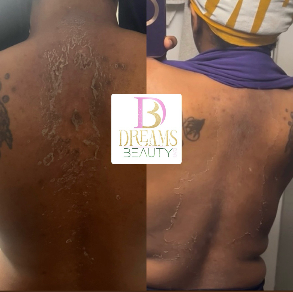 Corrective PEEL( BACK)