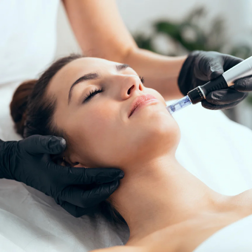 Microneedling at Wild Rose Med Spa in Chanhassen, MN
